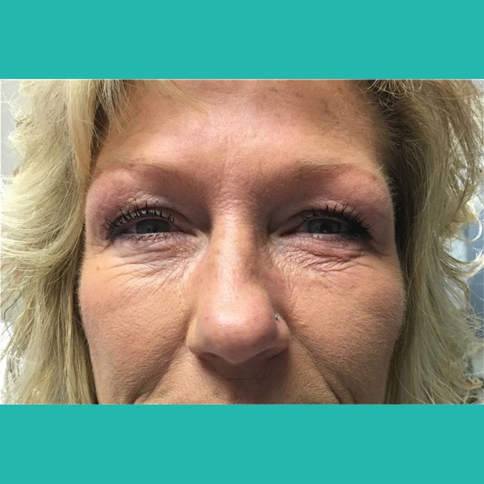 Öncesi-Sonrası 217 Before