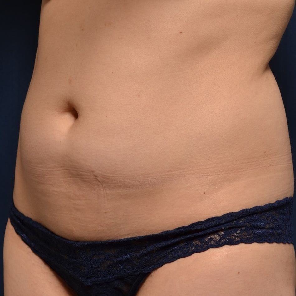 Öncesi-Sonrası 79 Before