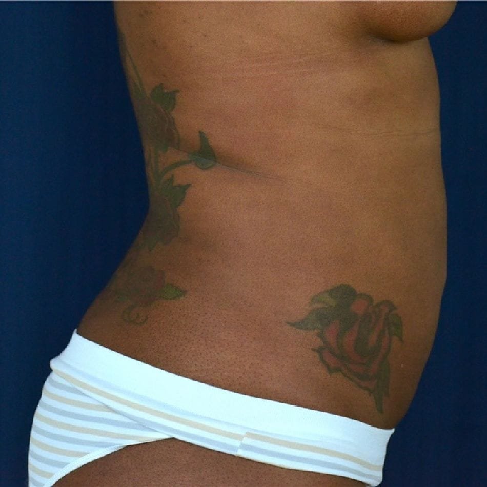 Öncesi-Sonrası 87 After