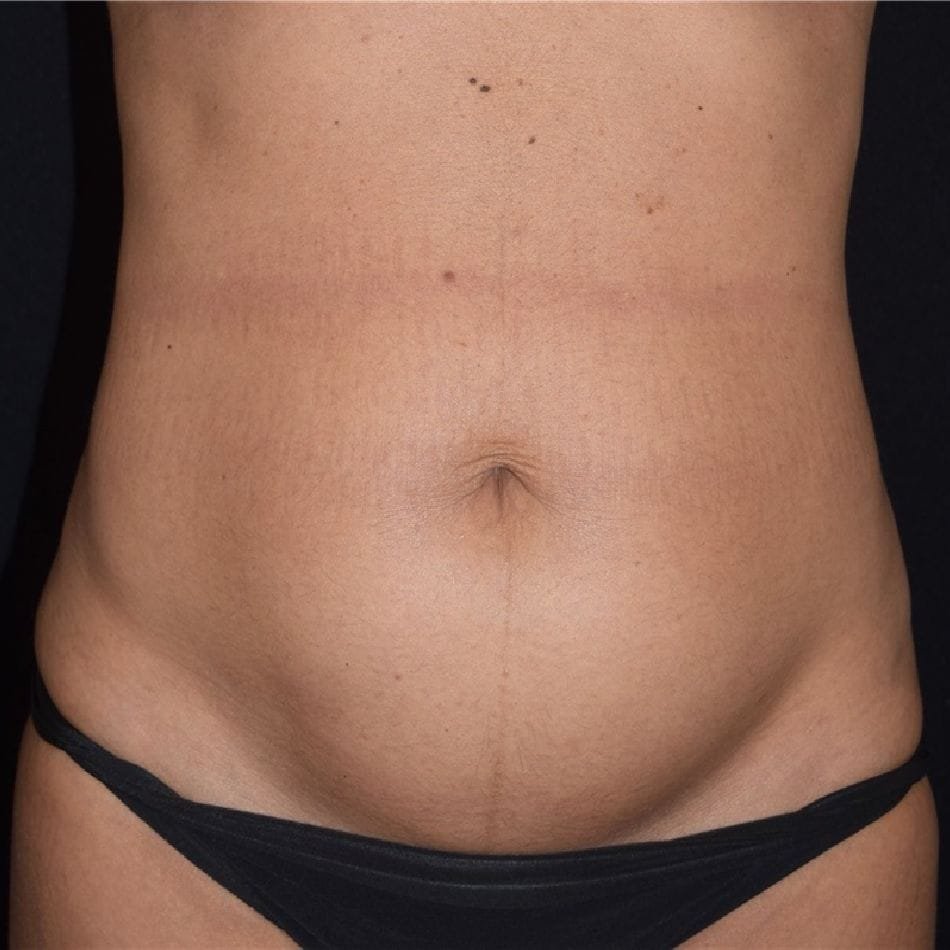 Öncesi-Sonrası 94 Before