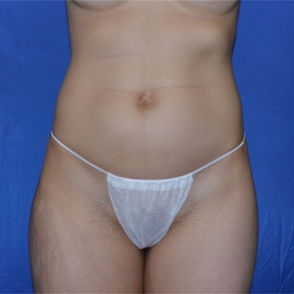 Öncesi-Sonrası 73 Before