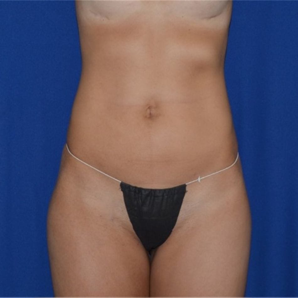 Öncesi-Sonrası 75 After