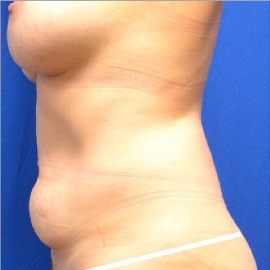 Öncesi-Sonrası 190 Before