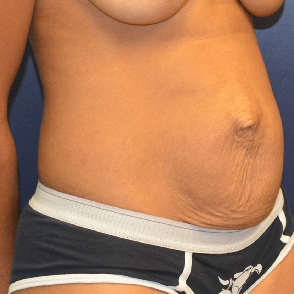 Öncesi-Sonrası 184 Before