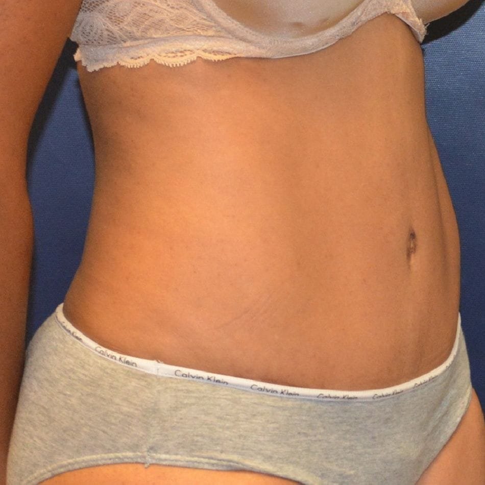 Öncesi-Sonrası 186 After