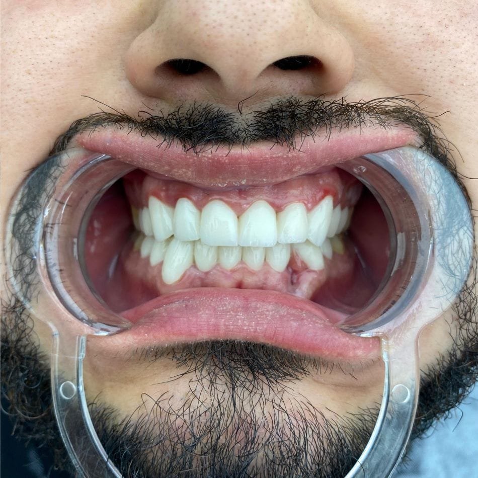 Öncesi-Sonrası 135 After