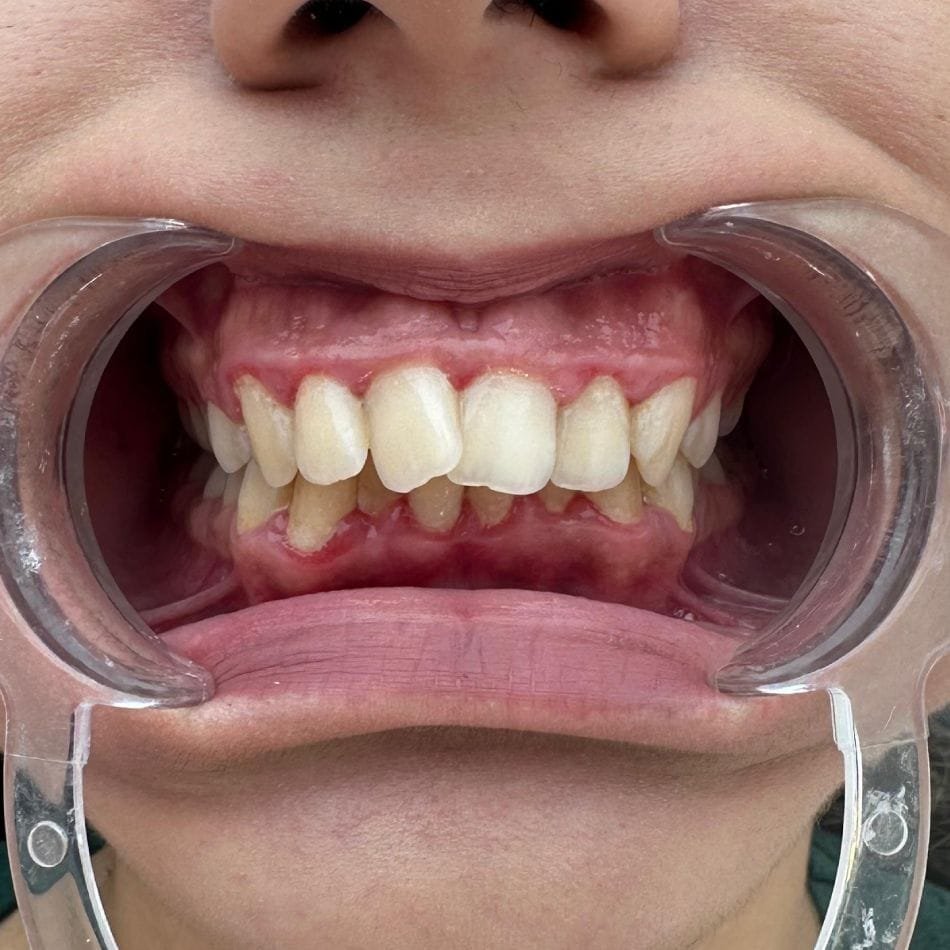 Öncesi-Sonrası 130 Before