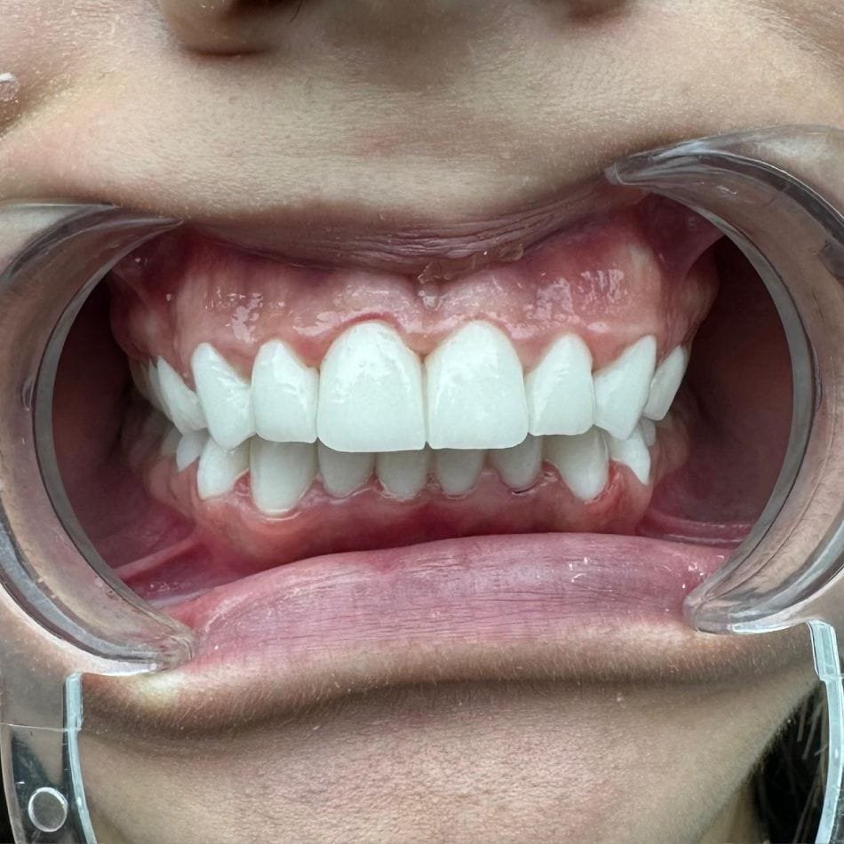 Öncesi-Sonrası 132 After