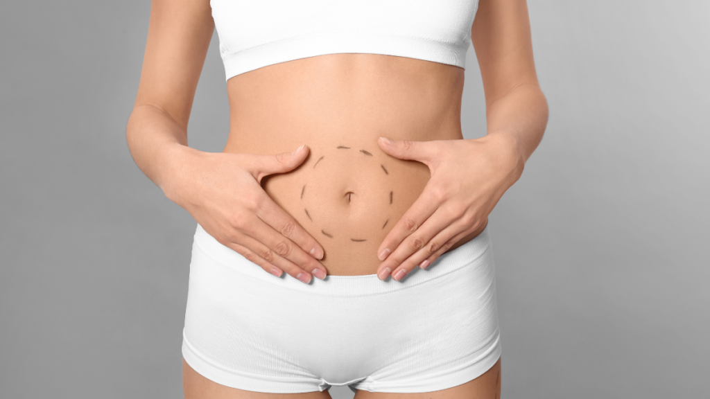 Tummy Tuck