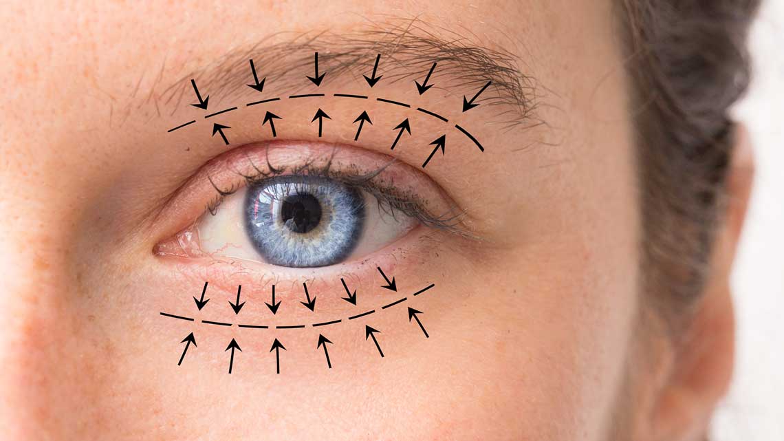 alfa heal eyelid aesthetics