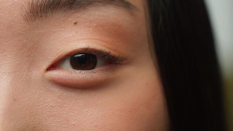 Blefaroplasti Galeri 4