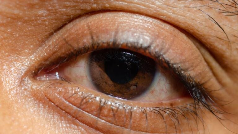 Blefaroplasti Galeri 3