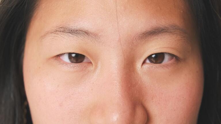 Blefaroplasti Galeri 2