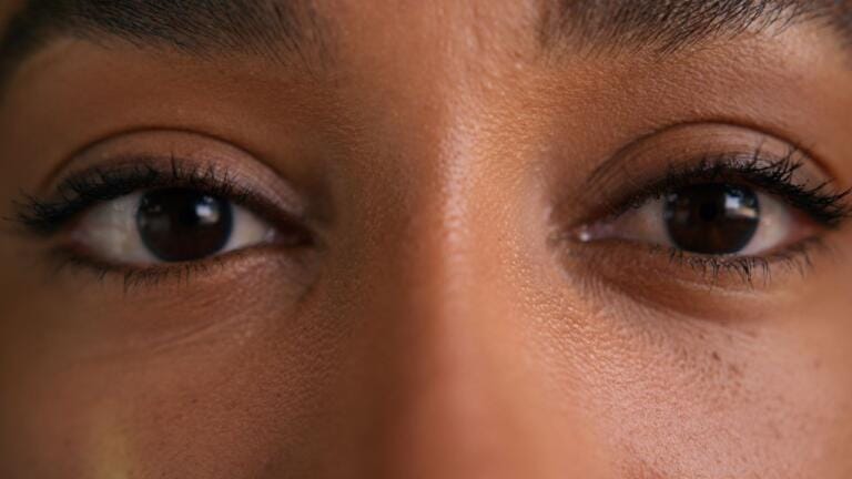 Blefaroplasti Galeri 1